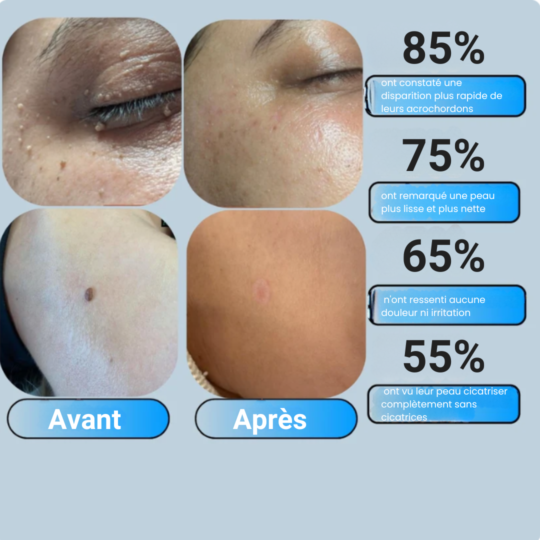 Kit de Suppression Acrochordons & anti-verrues
