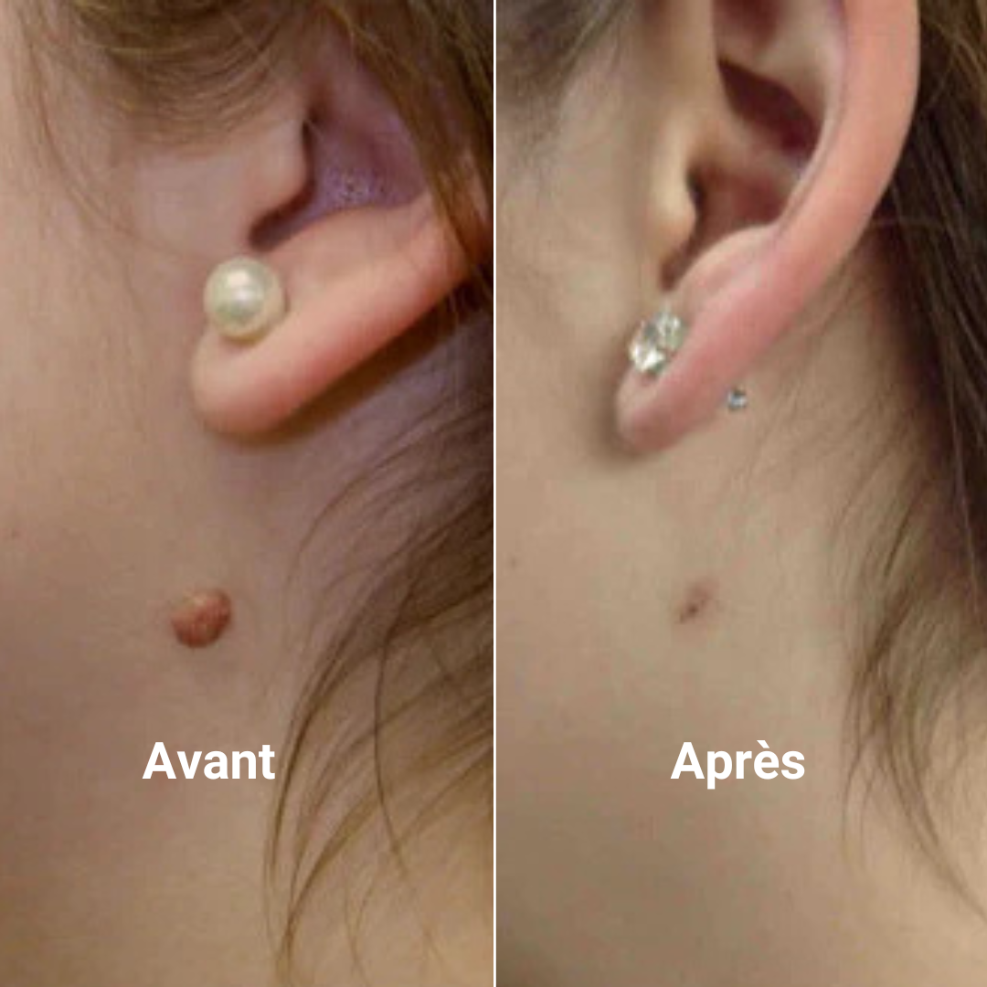 Kit de Suppression Acrochordons & anti-verrues