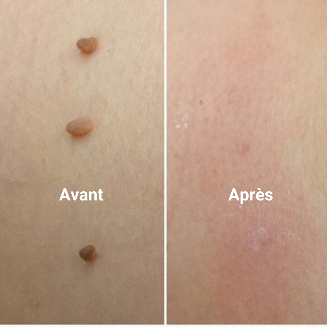 Kit de Suppression Acrochordons & anti-verrues